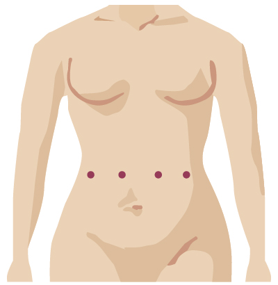 Robotic surgery incision from gynecologic surgery
