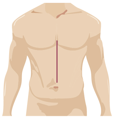 Traditional surgery incision for general robotic surgery