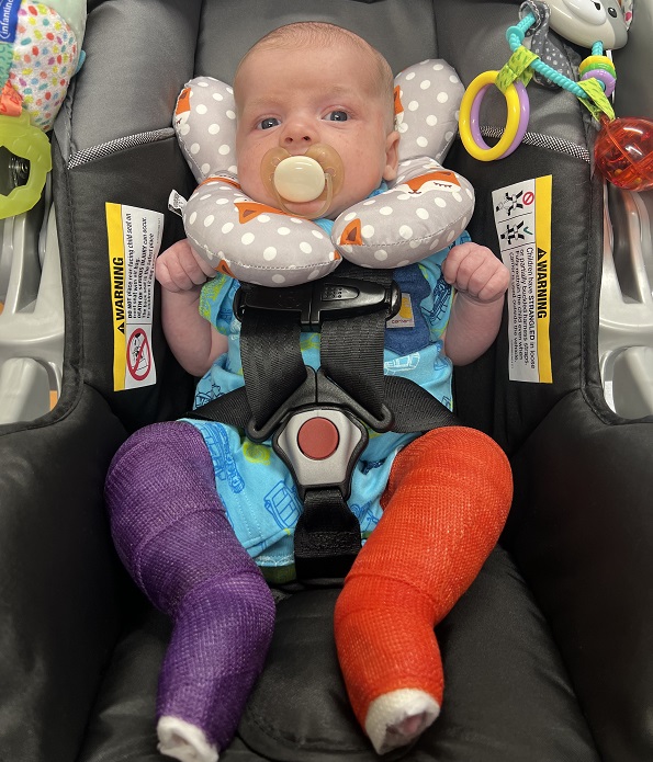 A baby with a pacifier in its mouth. The baby has a cast on each leg.